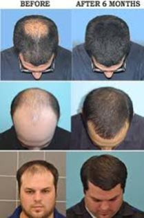 Hair Loss Treatment