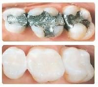 Dental Filling Material