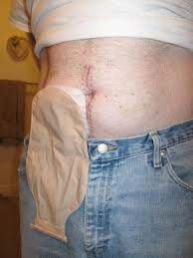 Colostomy Bag